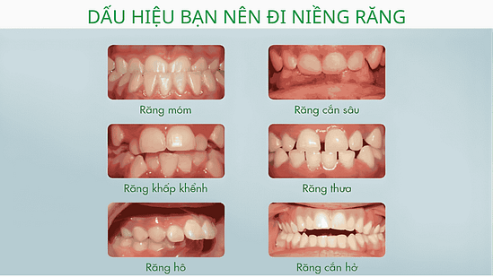 dấu hiệu bạn nên đi niềng răng tại nha khoa Mạnh Hùng