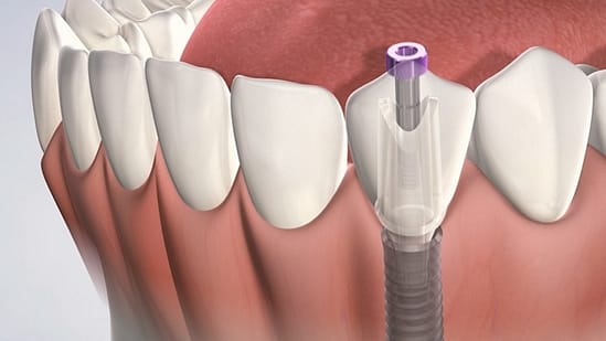 Cấy ghép implant tại nha khoa Mạnh Hùng