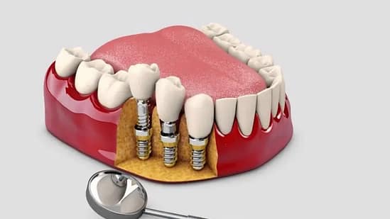 Trụ Implant có thể tồn tại bao lâu?