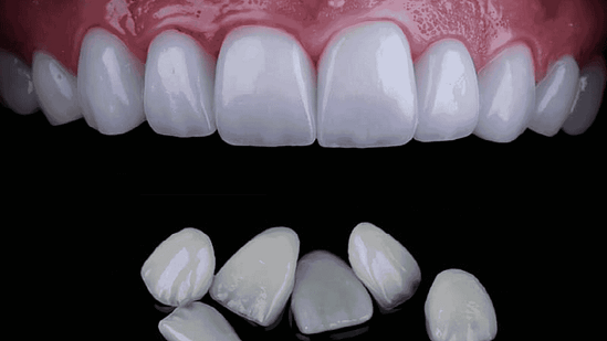 Dán sứ veneer tại nha khoa Mạnh Hùng