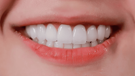 ưu điểm khi dán sứ veneer tại Nha khoa Mạnh Hùng