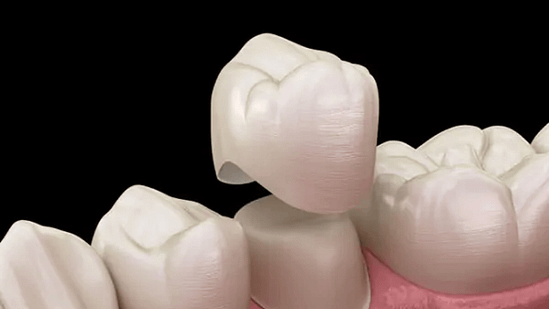 Bọc răng sứ Nha Khoa Mạnh Hùng