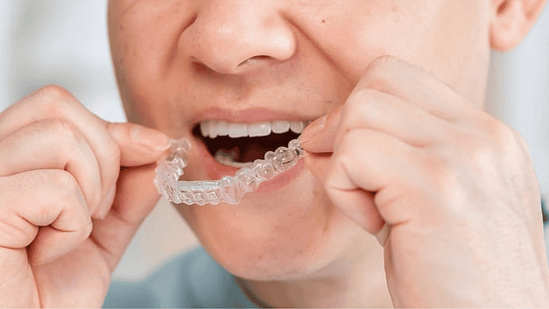 Niềng răng cho người trưởng thành: Có hiệu quả không? tại nha khoa Mạnh Hùng