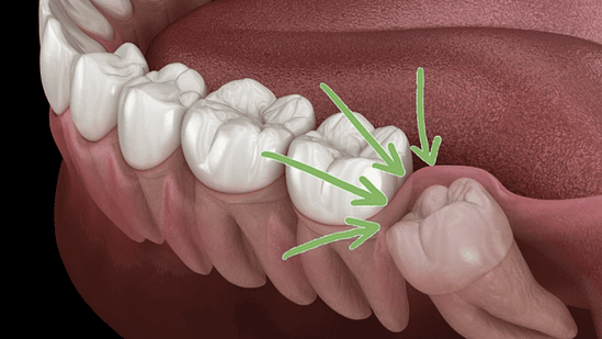 Khi nào cần nhổ răng khôn? 5 dấu hiệu cảnh báo nguy hiểm