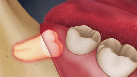 Vì sao nên nhổ răng khôn sớm? tại Nha khoa Mạnh Hùng