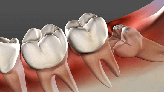 Những trường hợp không được nhổ răng khôn tại nha khoa Mạnh Hùng