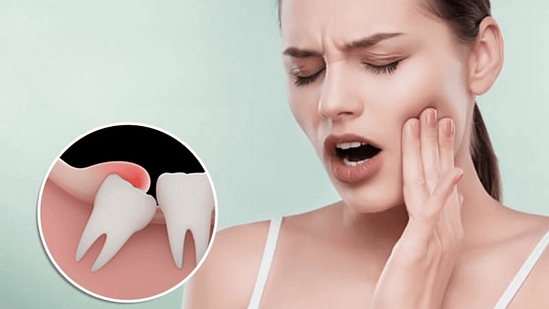 Khi nào nên trì hoãn nhổ răng khôn?