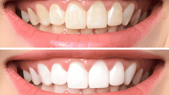 Tẩy trắng răng mang lại lợi ích gì