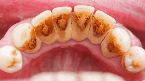 Bao lâu cạo vôi răng một lần thì tốt nhất?
