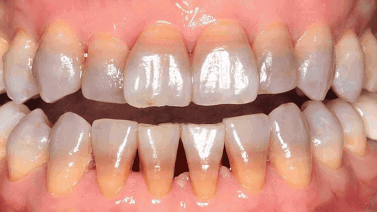 Cách khắc phục răng xỉn màu hiệu quả
