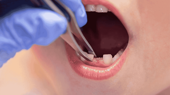 Khi nào trẻ cần nhổ răng?