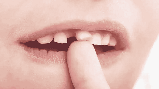 Cha mẹ cần chuẩn bị gì trước khi nhổ răng cho trẻ?