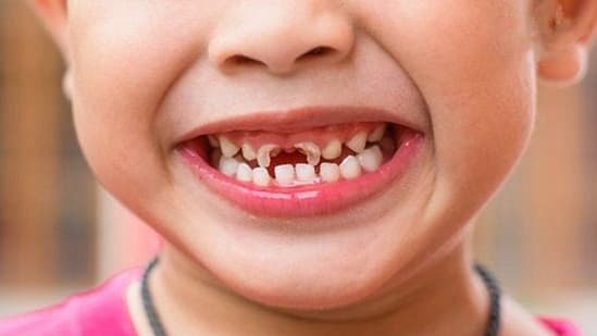 Các phương pháp điều trị sâu răng sữa