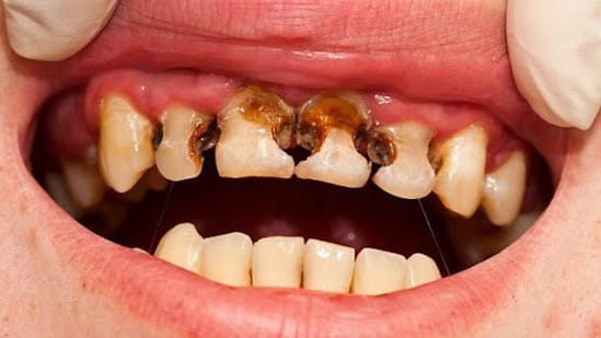 Sâu răng sữa: Có cần điều trị không?