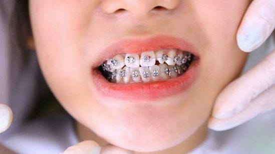 khi nào trẻ cần niềng răng