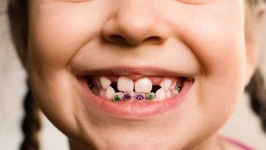 Các giai đoạn niềng răng lý tưởng cho trẻ