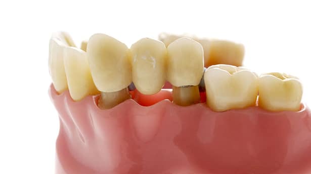 Cầu răng sứ có bền không?