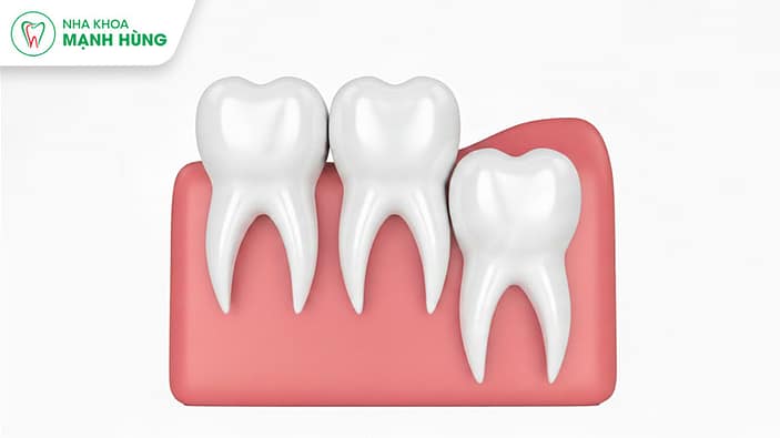 Tình trạng răng khôn mọc lệch và mọc ngầm