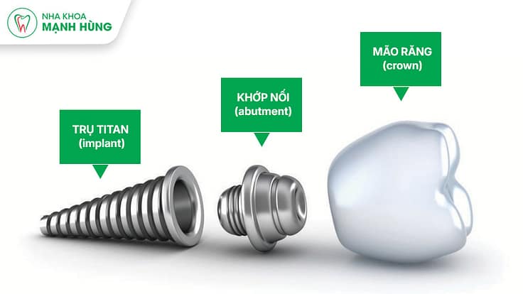 Cấu trúc răng Implant