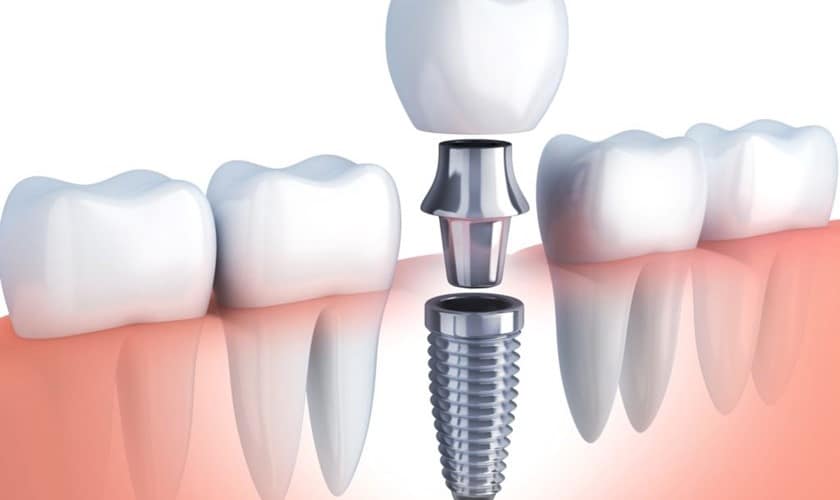 Trồng răng implant là gì? Giá bao nhiêu tiền tại Nha khoa Mạnh Hùng