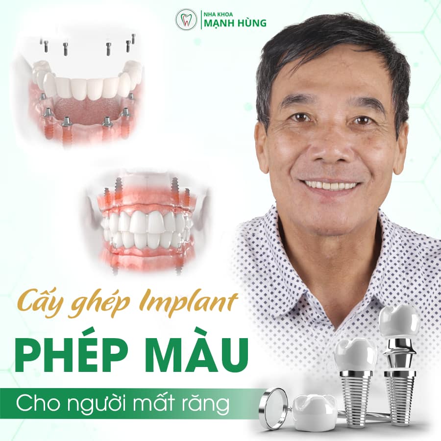 Cấy ghép Implant - Mất răng không còn là nỗi lo